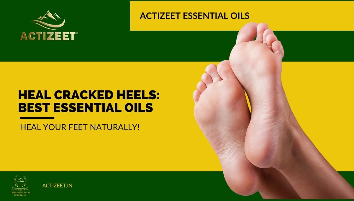 what essential oil is good for cracked heels