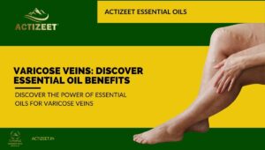 what essential oil is good for varicose veins