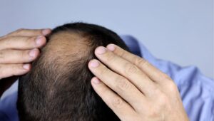 Can rosemary oil prevent hair loss