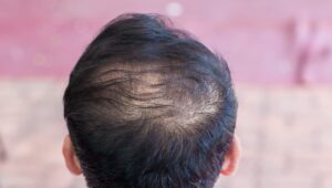 Can rosemary oil reverse hair thinning
